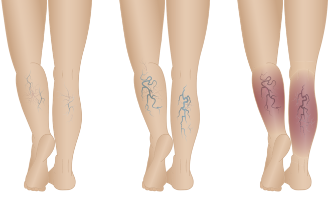 Giornata prevenzione insufficienza venosa nella donna